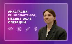 Анастасия. Ринопластика. Месяц после операции