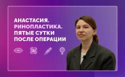 Анастасия. Ринопластика. 5 сутки после операции