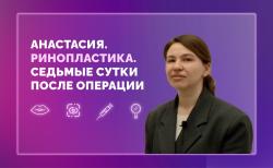 Анастасия. Ринопластика. 7 сутки после операции