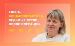 Елена. Блефаропластика. 7 сутки после операции