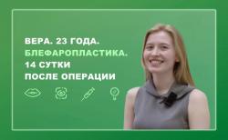 Вера. 23 года. Блефаропластика. 14 сутки после операции