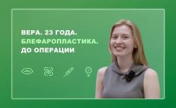 Вера. 23 года. Блефаропластика. До операции