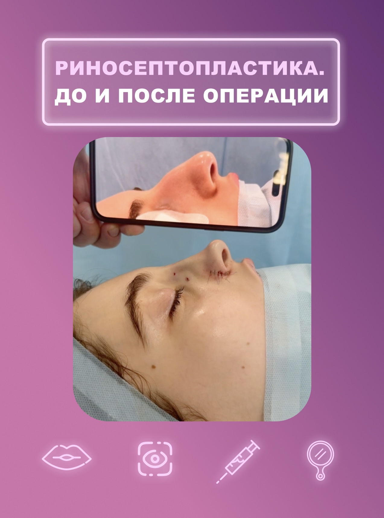 Завершение риносептопластики нашей пациентки